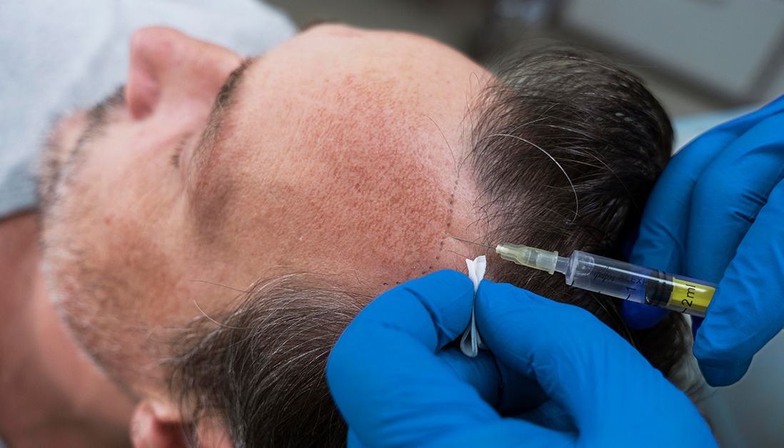Hair transplant Istanbul with Expert Consultation and Planning